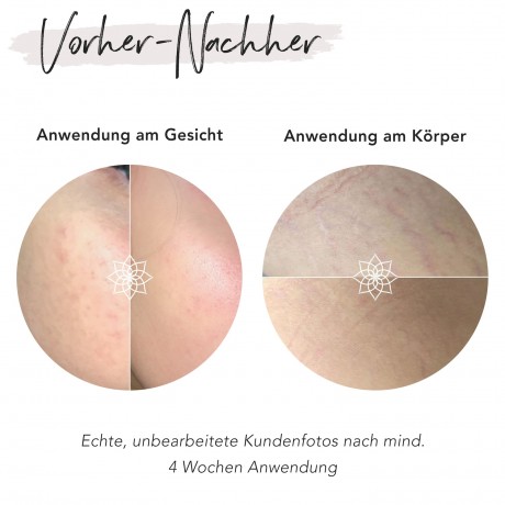 FACES OF FEY Microneedlingset Basic Hyaluron 0,75mm Набор для микронидлинга Basic Hyaluron 0,75 мм