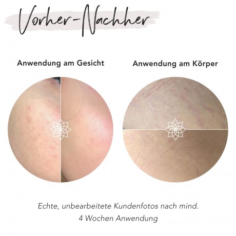 FACES OF FEY Microneedlingset Basic Hyaluron 0,5mm Набор для микронидлинга Basic Hyaluron 0,5 мм